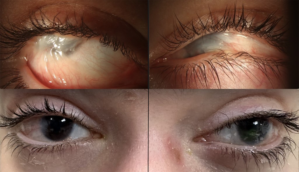 Der 14-jährige Patient litt bereits seit Jahren an der Erbkrankheit Epidermolysis bullosa dystrophica. Die Anwendung des Gentherapeutikums, die schon seine schlimmen Hautläsionen gebessert hatte, haben Forschende nun auch erstmals am Auge angewendet und konnten ihn so vor der Erblindung bewahren (oben: vor der Gentherapie, unten:  danach). / Foto: Miller School of Medicine