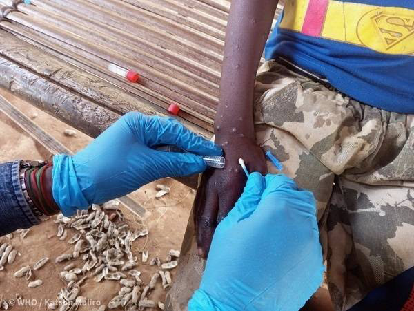 Mpox kann gerade bei Kindern und Jugendlichen  einen schweren Verlauf nehmen. In der EU wurde der Mpox-Impfstoff Imvanex nun für 12- bis 17-Jährige zugelassen.  / Foto: Imago/WHO/Aton Chile